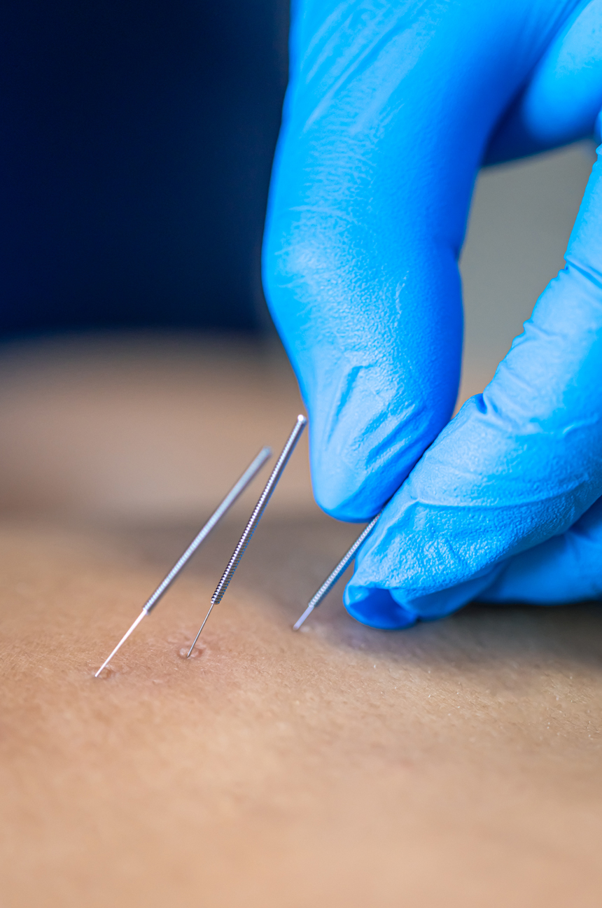 Dry Needling vs. Acupuncture